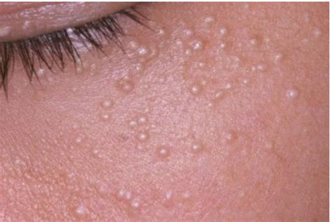 Milialar Skin Disease Causes Symptoms And Cure