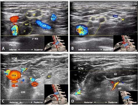 Doppler Ultrasound Imaging Of The Transverse Cervical Artery