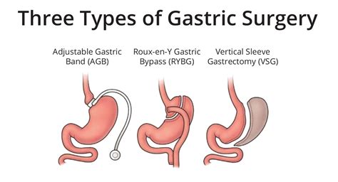 Gastric Surgery Types To Choose Weight Loss Surgery