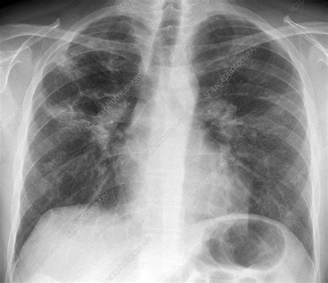 Check spelling or type a new query. Berylliosis, X-ray - Stock Image - C014/7016 - Science Photo Library