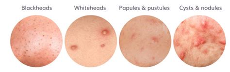 Types Of Acne Scars You Should Know M Aesthetic Clinic