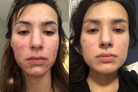Thank Goodness For Curology And Birth Control 5 Months Apart Acne