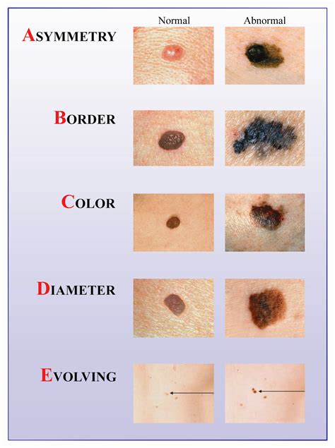 Bibliography Skin Cancer And Preventions