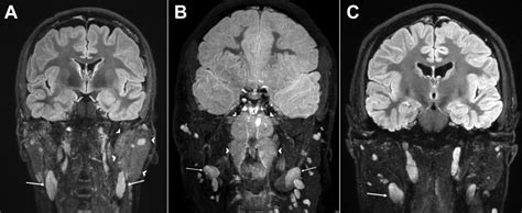 Mri Of Patients Infected With Covid 19 Revealed Cervical