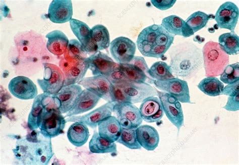 LM Of Cervical Smear Chlamydia Infection Stock Image M862 0034