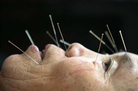 Chinese medicine is now often referred to as east asian medicine to avoid offending and to acknowledge the traditions of practitioners from vietnam, korea, and japan. Tiny needle, big role -- the rebirth of acupuncture in ...