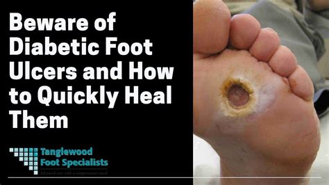 Beware Of Diabetic Foot Ulcers And How To Quickly Heal Them Youtube