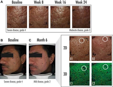 Adapalene 3 Acne Scar Improvement Study Whats Been Your Experience