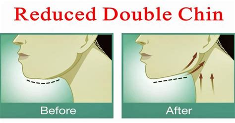How To Get Rid Of A Double Chin And Neck Fat Dailyhealthpost