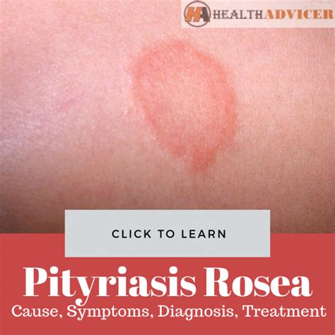 Pityriasis Its Possible That The Rash Could Be Something Other Than