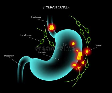 Stomach Cancer Anatomy Stock Vector Illustration Of Tumor 230464013