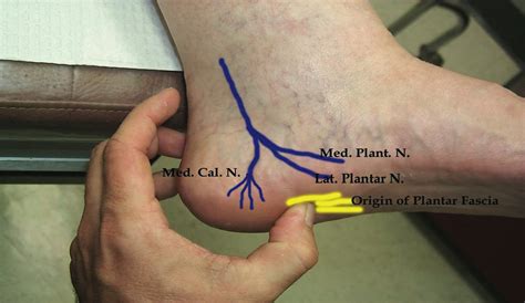 A Runners Progress Tibial Nerve As A Source Of Plantar Heel Pain