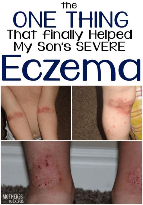 Goodbye Eczema In 2020 Eczema Eczema Remedies Severe Eczema