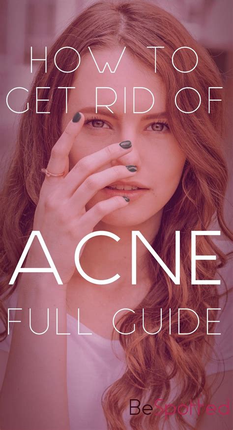 How To Get Rid Of Acne Full Guide How To Get Rid Of Acne Acne