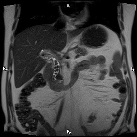 Cholelithiasis And Choledocholithiasis Radiology Case Radiopaedia Org