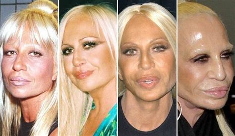 Donatella Versace Plastic Surgery Transformations Celebrity Plastic