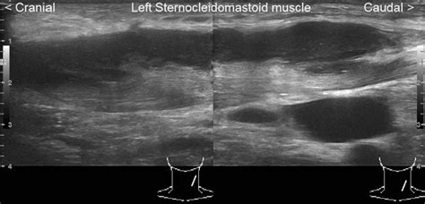 Sternocleidomastoid Muscle Swelling
