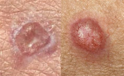 Main Type Of Skin Cancer Their Differences Histology And Prevention
