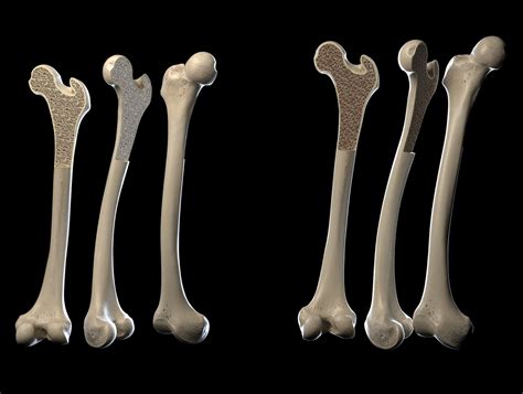 Human Leg Bone Illustration By Garisson Medical Visualization 3d