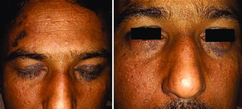 A Dark Slate Gray Hyperpigmented Patches On Both Upper Eyelids And