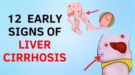 Danger 12 Early Signs Of Liver Cirrhosis Youtube