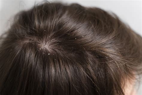 How To Remove Dandruff Causes Signs And Treatments