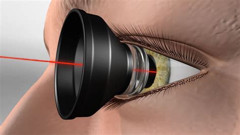 Focal Retinal Laser Procedure Fraser Valley Cataract And Laser