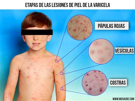 Varicela síntomas contagio tratamiento y vacuna