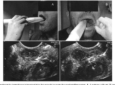 Pdf Intraoral Ultrasound In The Diagnosis And Treatment Of Suspected