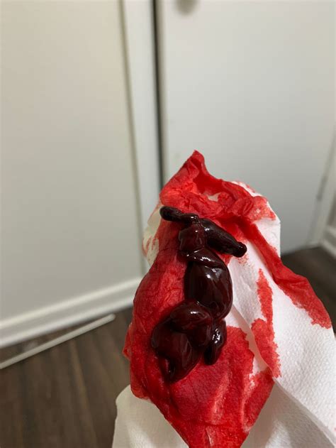 Pictures of spotting during pregnancy. Heavy Bleeding In Early Pregnancy 2 Weeks - PregnancyWalls