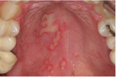 Benign Infectious Lesionsconditions Of The Oral Mucous Membrane Intechopen