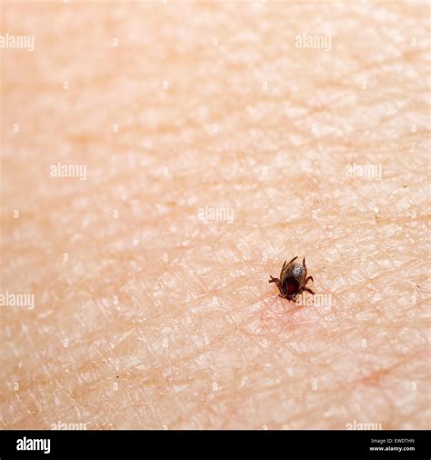 Small Tick Insect With Head Buried In Human Skin Disease Risk Stock