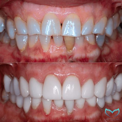Composite Vs Porcelain Veneers You Need Everything