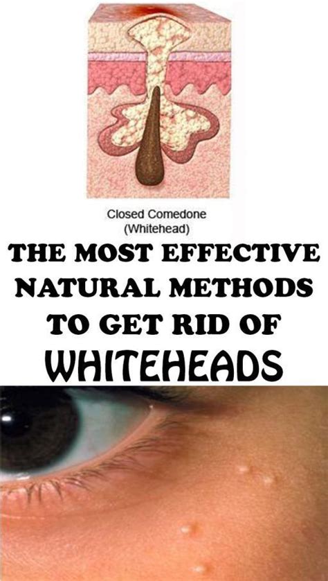 8 Ways To Get Rid Of Whiteheads At Home Spots On Face Brown Spots On