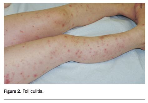 A Girl With An Itchy Vesicular Rash Medicine Today