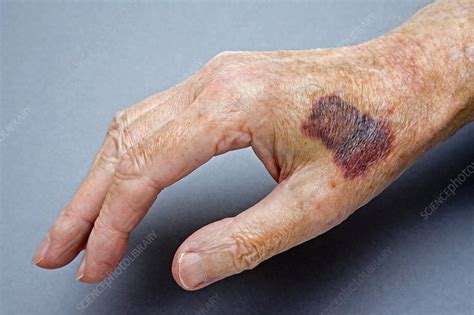 Bruised Hand Stock Image M3301712 Science Photo Library