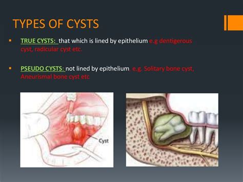 Cysts Of Oral Regions