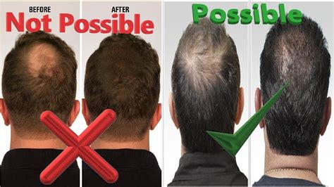 Prp Hair Loss Treatment Before And After Prp Hair Treatment Results