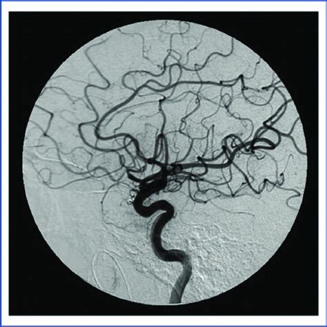 Case 2 Angiography Showing Active Extravasation Of Contrast At The