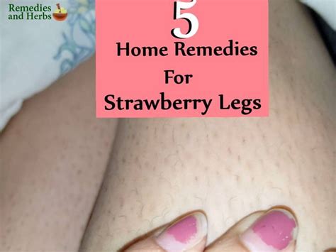 Strawberry Legs Medically Termed As Open Comedone Are Visible Dark