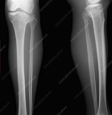Tibial Plateau Fracture X Ray Stock Image F0360256 Science