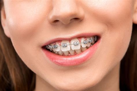 10 Things You Should Know Before Getting Braces Best Option