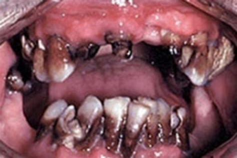 Or, these symptoms might be caused by a medical condition that is not cancer. What does a meth mouth look like? - Quora
