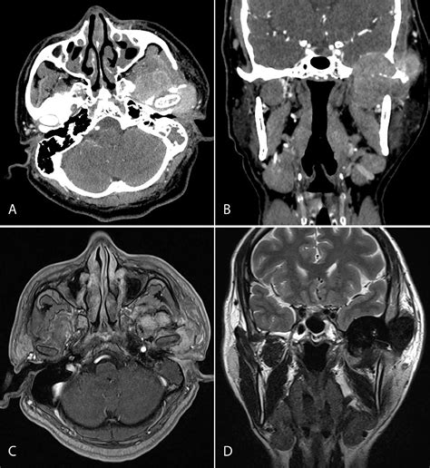 Diffuse Type Tenosynovial Giant Cell Tumor Of The Temporomandibular