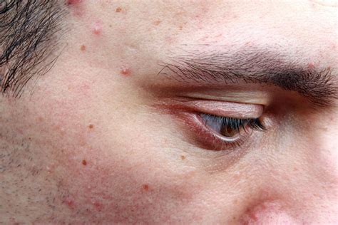 Skin Conditions Acne Healthstatus