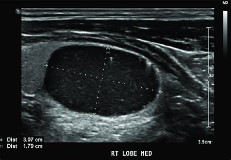 Ultrasound Of Thyroid Showed A Right Lobe Nodule Located At Mid To Download Scientific Diagram