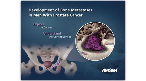 Bone Metastases In Men With Prostate Cancer Ann Marie Wayne