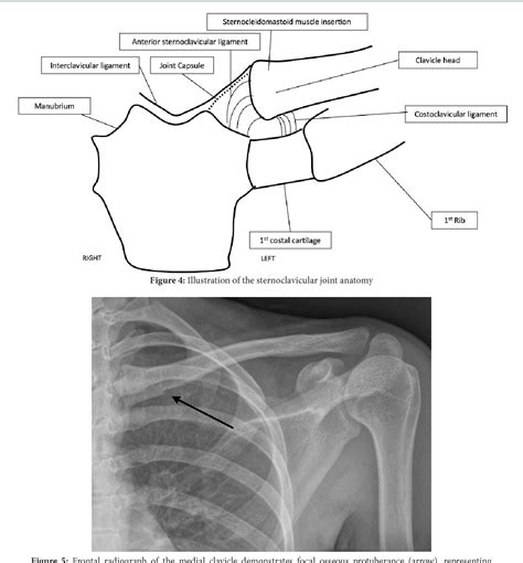 Pdf Clavicle Fractures Allman And Neer Classification Semantic Scholar