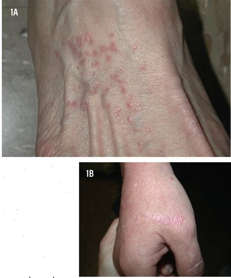 Seeing The Spectrum Recognizing Lichen Planus In Various Skin Types