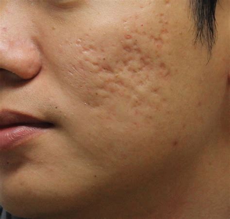 How To Remove Pimple Scars Acne Scar Treatment Singapore